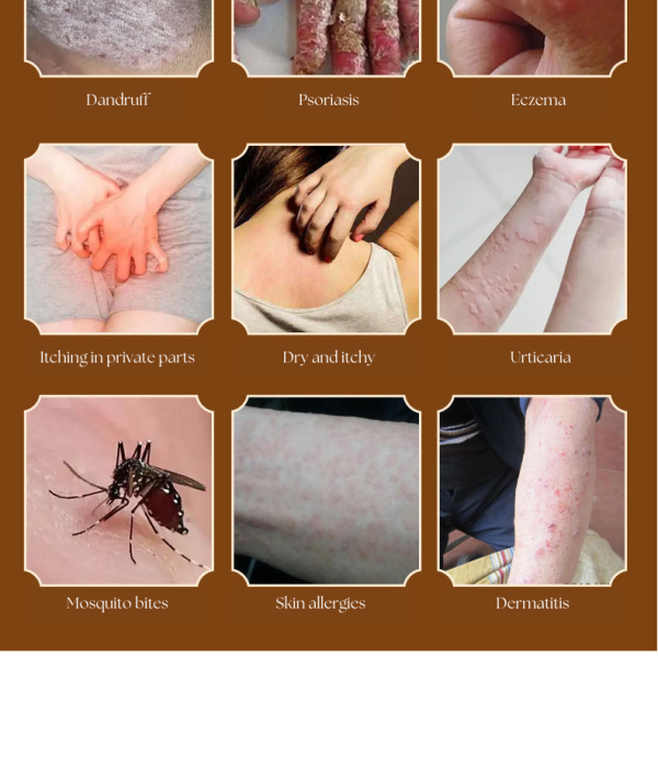 YifuningⓇ Psoriasis & Tinea Ointment - Image 5
